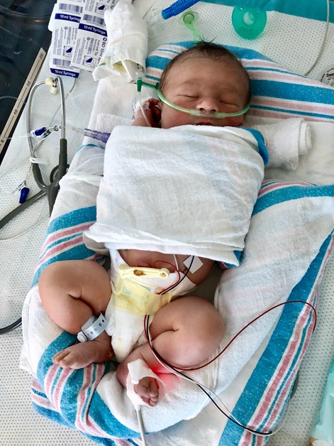 ryder nicu nasal cannula